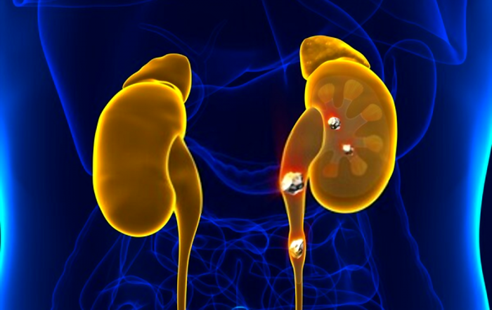 stone kidneys