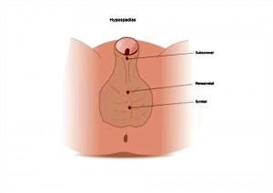 hipospadia 5